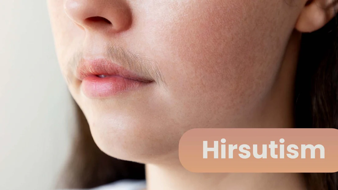 hirsutism