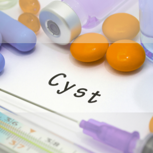 cysts